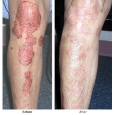 AROGYAM PURE HERBS_br_  KIT FOR PSORIASIS-228x228