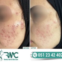 Laser Treatment For Acnes cars in Islamabad - Acnes cars Removal in Islamabad - Best Acnes cars Removal Clinic In Islamabad - Best Treatment For Acnes cars In Islamabad - Acne Scars Removal In ISB